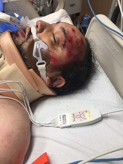 Black man lying in hospital bed with red blotches all over his face with a breathing machine and neck brace