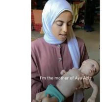 Mother holding malnourished baby