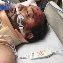Black man lying in hospital bed with red blotches all over his face with a breathing machine and neck brace