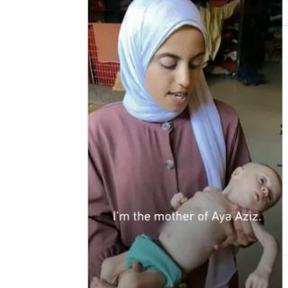 Mother holding malnourished baby